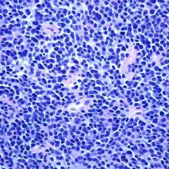 ewing sarcoma